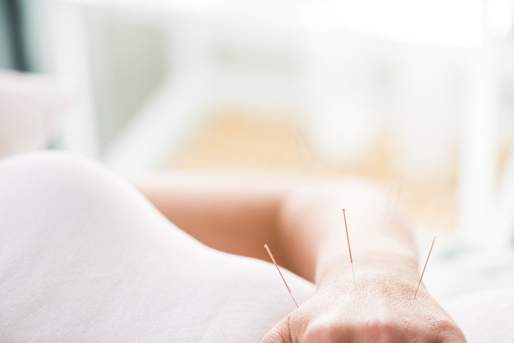 Acupuncture